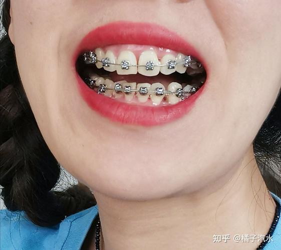 矫正牙齿取了虎牙-图2 矫正牙齿取了虎牙-图2