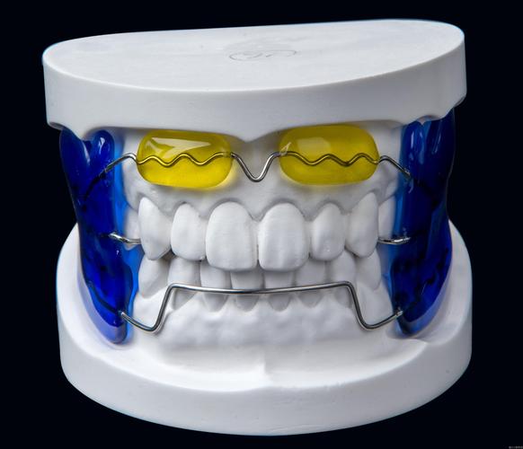 正轴簧在牙齿矫正中的作用原理和效果如何？-图2