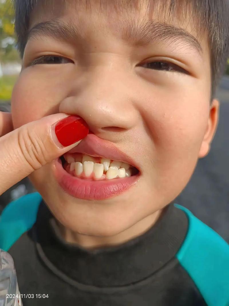 地中海贫血患者牙齿畸形矫正有哪些特殊考量？-图3