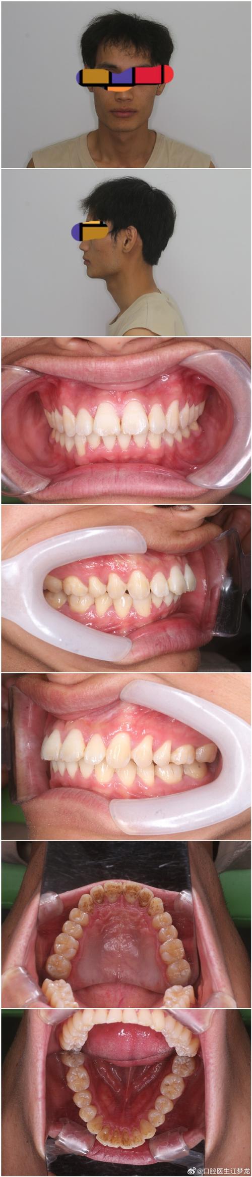畸形矫正牙齿图片能直观看到哪些牙齿矫正变化细节？-图2