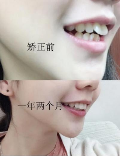 兔子牙矫正有哪些方法？效果能维持多久？-图1