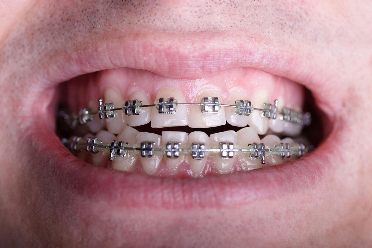 广州牙齿钢丝矫正效果如何？需要多久见效？-图1