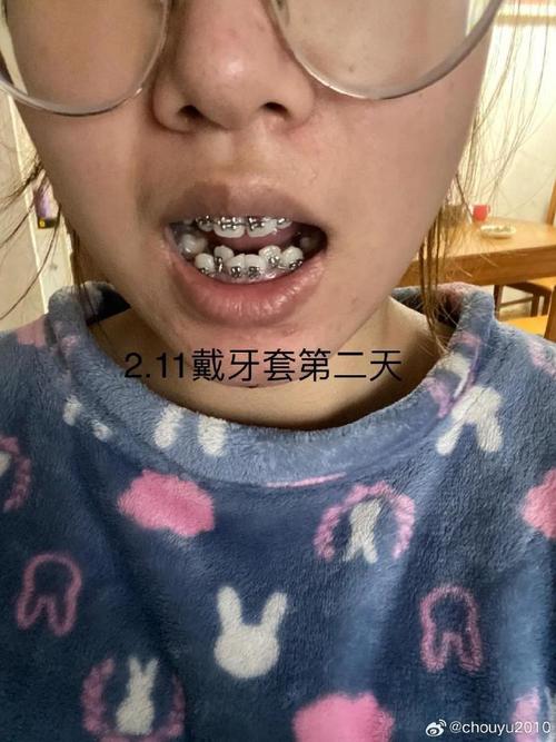 钢丝矫正牙齿前期，需做哪些准备及避免哪些事项？-图3