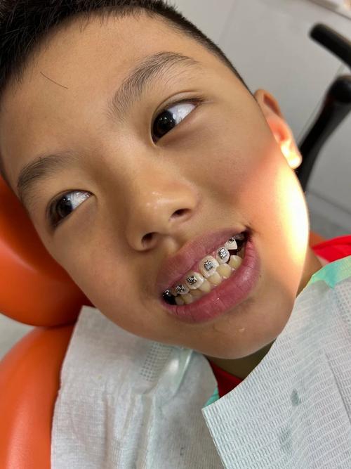 苏州小孩矫正牙齿，最佳年龄、方法及费用如何选？-图1