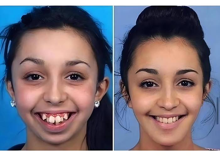 牙齿矫正真的能让脸型变得更对称吗？-图1