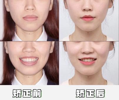牙齿矫正真的能让脸型变得更对称吗？-图3