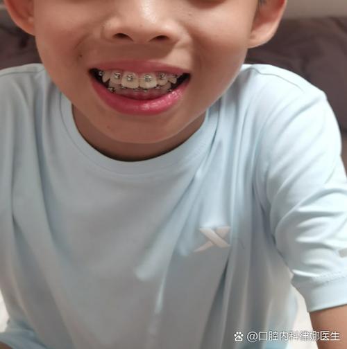 自己矫正牙齿不齐靠谱吗？效果和安全如何？-图3