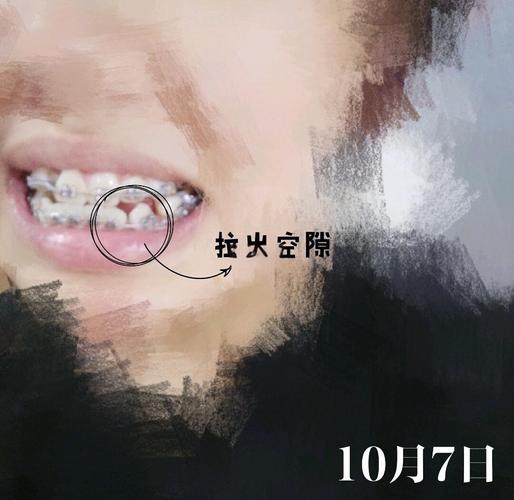 牙齿矫正弹簧牵引如何精准移动错位牙?-图1 牙齿矫正弹簧牵引如何精准移动错位牙?-图1