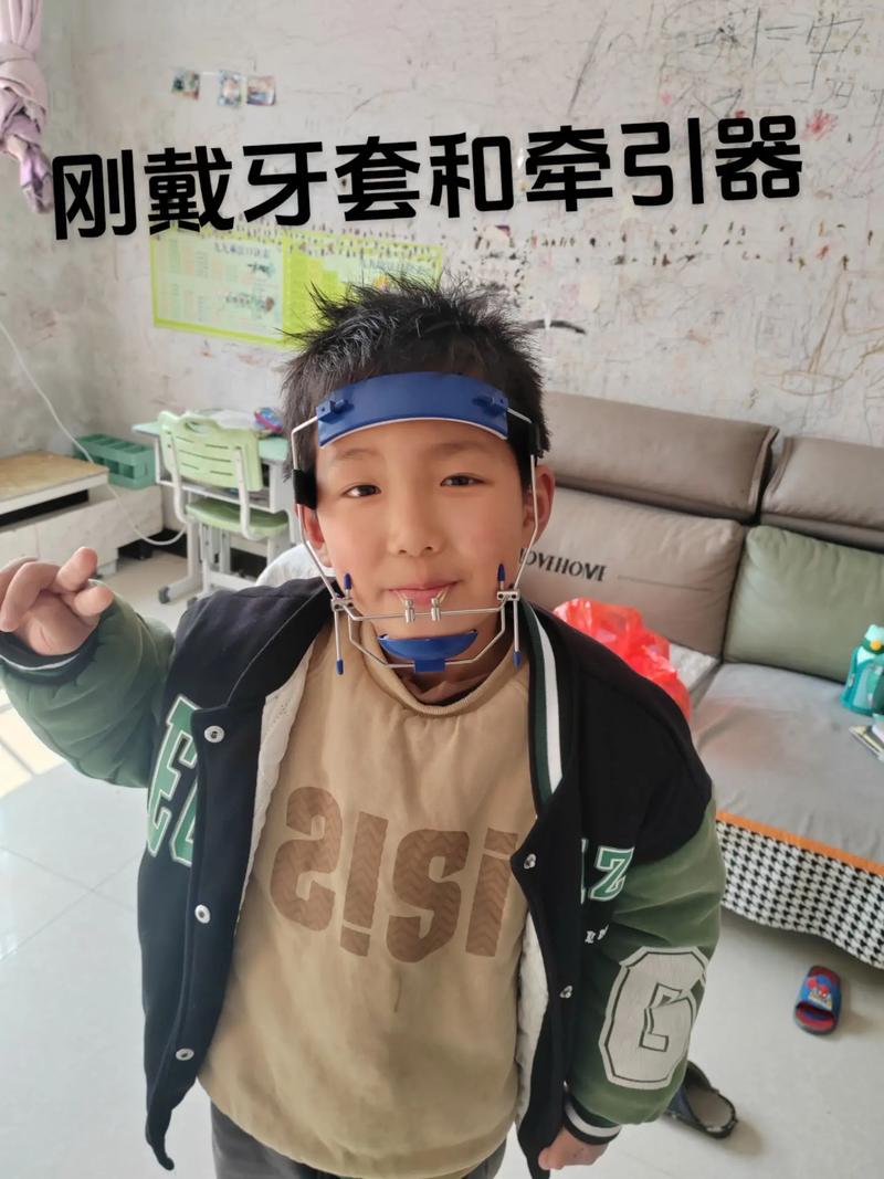 牙齿矫正弹簧牵引如何精准移动错位牙?-图3 牙齿矫正弹簧牵引如何精准移动错位牙?-图3