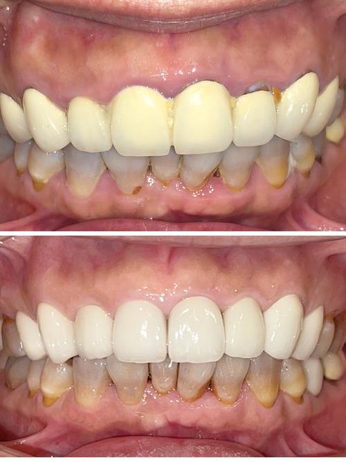 牙齿矫正烤瓷牙图片效果如何？真实案例能参考吗？-图1