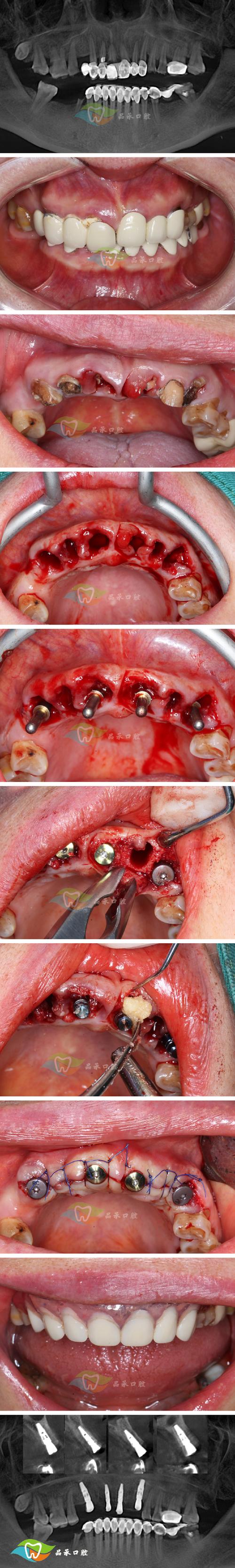 牙齿矫正为何会引起牙齿创伤?-图1 牙齿矫正为何会引起牙齿创伤?-图1