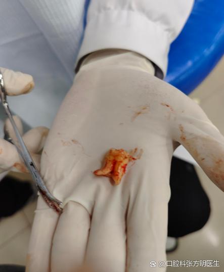 牙齿矫正为何会引起牙齿创伤?-图2 牙齿矫正为何会引起牙齿创伤?-图2