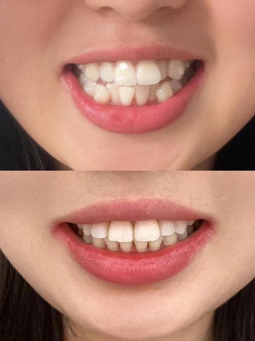 深圳隐形牙齿矫正效果如何?要戴多久?价格怎么样?-图2 深圳隐形牙齿矫正效果如何?要戴多久?价格怎么样?-图2