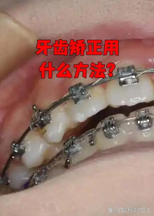 牙齿缺失可以矫正-图3