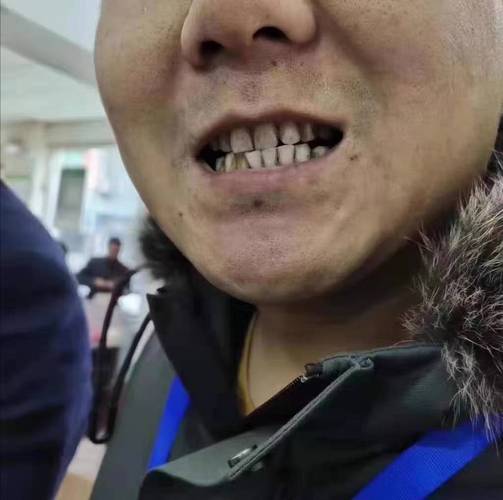 矫正牙齿期间抽烟，可以吗？会有哪些危害？-图3