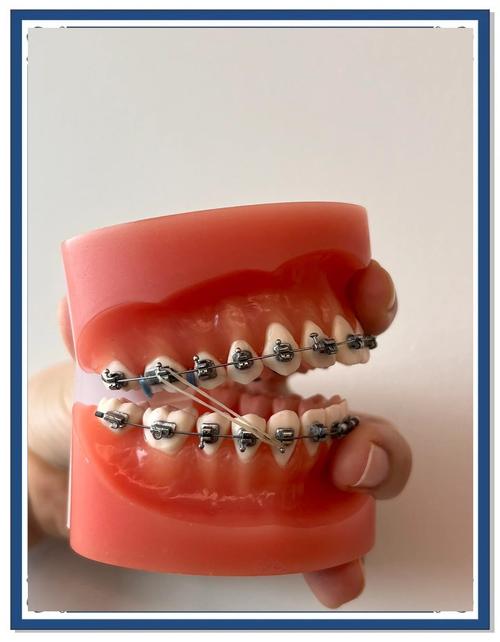 矫正牙齿需要用到哪些必备器械？-图3