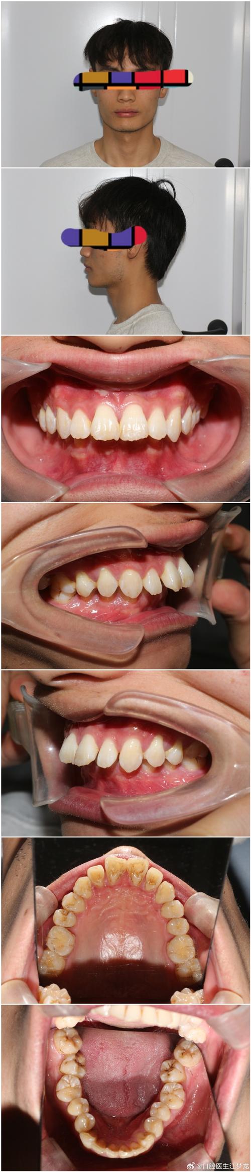 下颚突出矫正，牙齿矫正能改善脸型吗？-图1