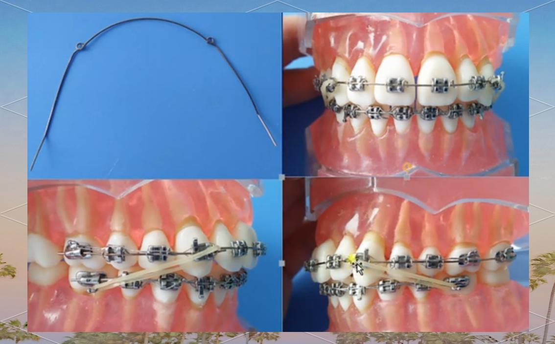 LH牙齿矫正技术效果如何？优势与安全性怎样？-图3