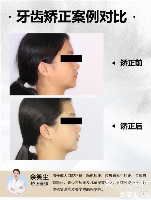 杭州牙齿烤瓷矫正-图2