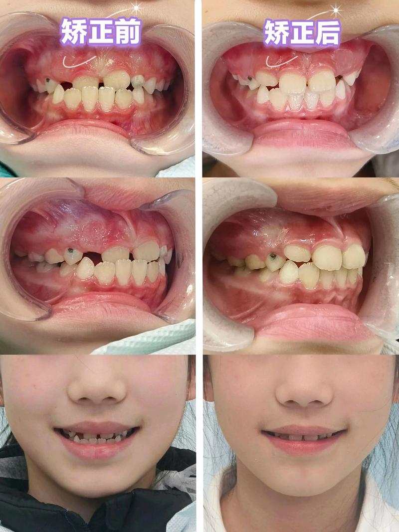 东莞小孩矫正牙齿，家长需关注哪些关键问题？-图2