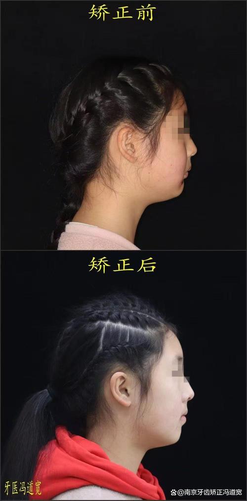 南京明星牙齿矫正为何成热门选择?效果和医生技术如何?-图2 南京明星牙齿矫正为何成热门选择?效果和医生技术如何?-图2
