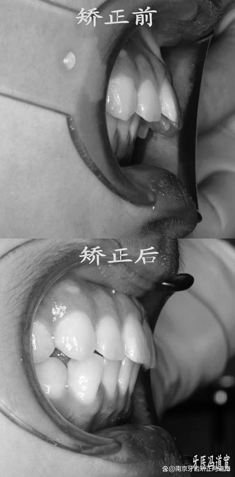 南京明星牙齿矫正为何成热门选择?效果和医生技术如何?-图1 南京明星牙齿矫正为何成热门选择?效果和医生技术如何?-图1