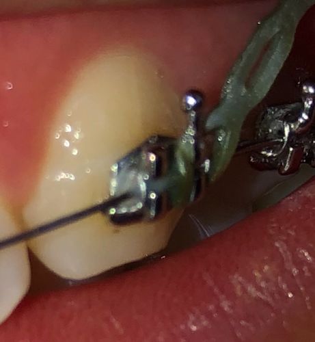 牙齿矫正后牙齿出现裂纹是何原因？-图2