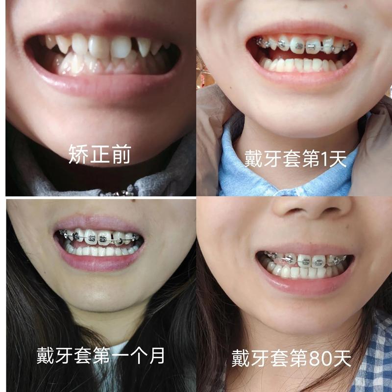 成人牙齿矫正可行吗？年龄会影响矫正效果吗？-图3