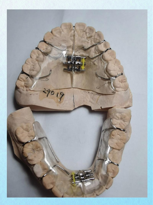 矫正牙齿如何实现弓形重塑？-图1