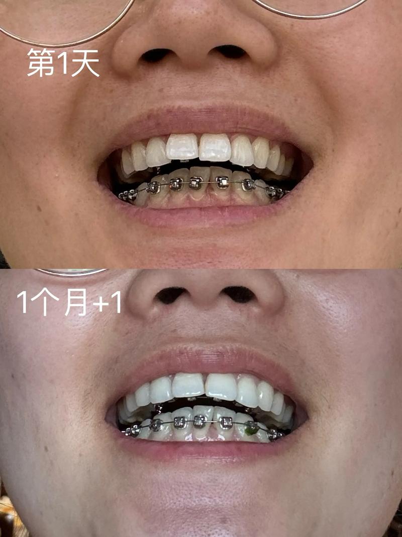 牙齿矫正钢丝脱离是什么原因？如何正确处理？-图1