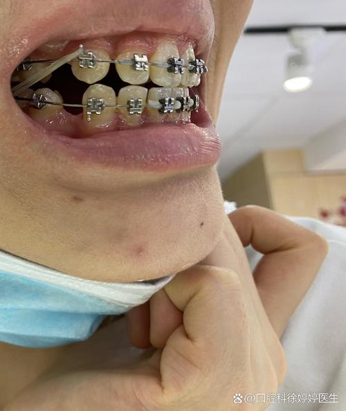 牙齿矫正钢丝脱离是什么原因？如何正确处理？-图3
