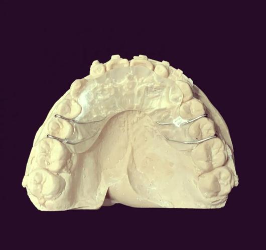 牙齿矫正导板图片能看出矫正效果吗?-图1 牙齿矫正导板图片能看出矫正效果吗?-图1