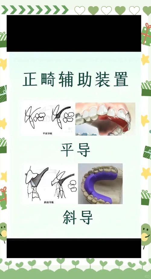 牙齿矫正导板图片能看出矫正效果吗?-图3 牙齿矫正导板图片能看出矫正效果吗?-图3