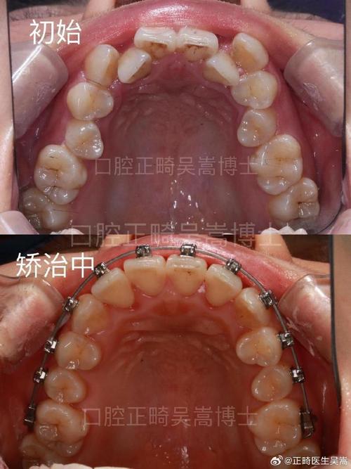 矫正牙齿会导致牙根收缩吗？-图3