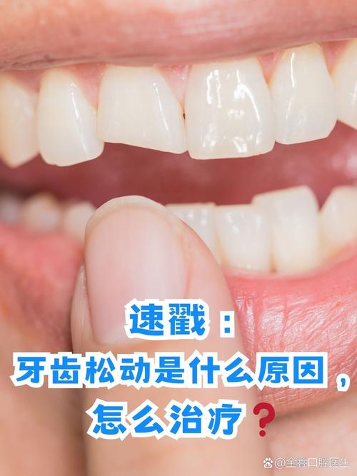 孕妇矫正牙齿松动-图3