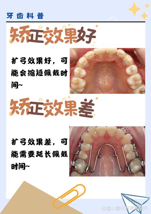 矫正牙齿排齐需要多久？-图1