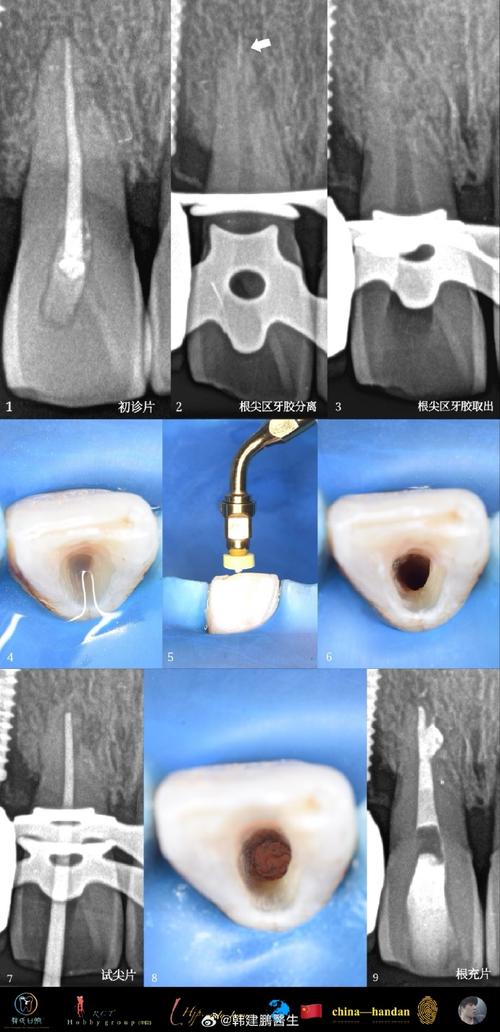 矫正牙齿为何会出现压根吸收？会影响牙齿健康吗？-图2