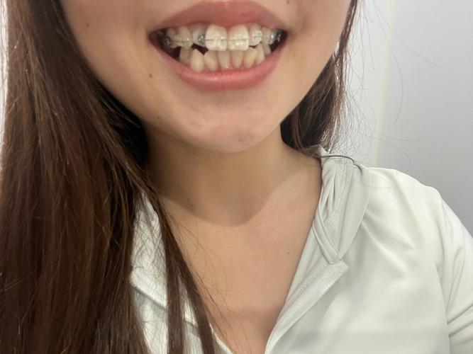 矫正牙齿后牙齿变弯？背后原因究竟是什么？-图2