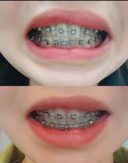 矫正完牙齿后牙齿为什么会变软？需要担心吗？-图1