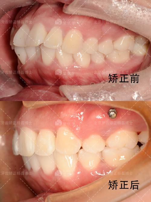 双颌前突矫正，如何达到理想效果？-图2