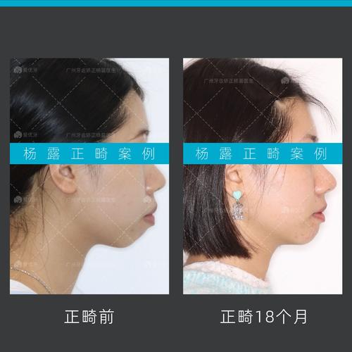 双颌前突矫正，如何达到理想效果？-图3
