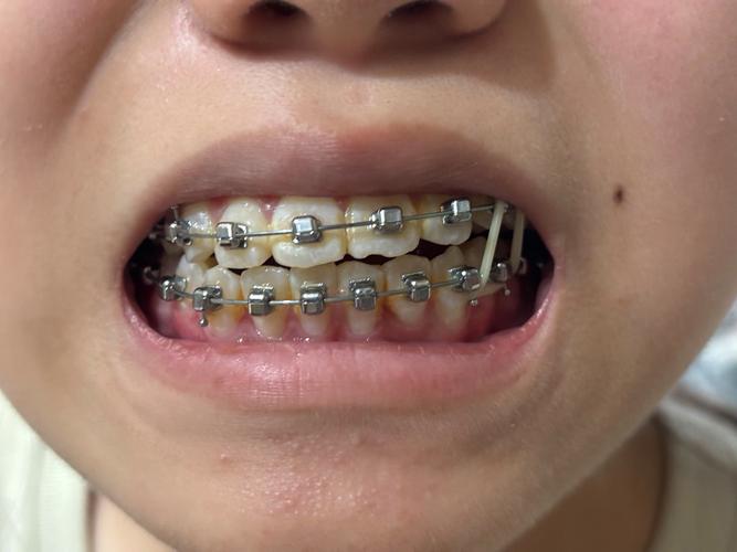 矫正牙齿要拔牙齿-图3