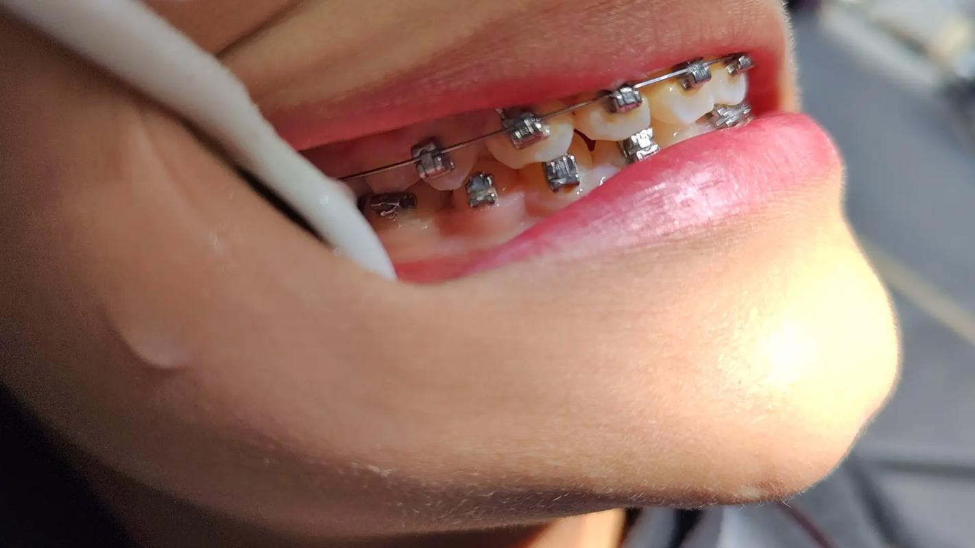 宁波矫正牙齿怎么选？哪家好又划算？-图3