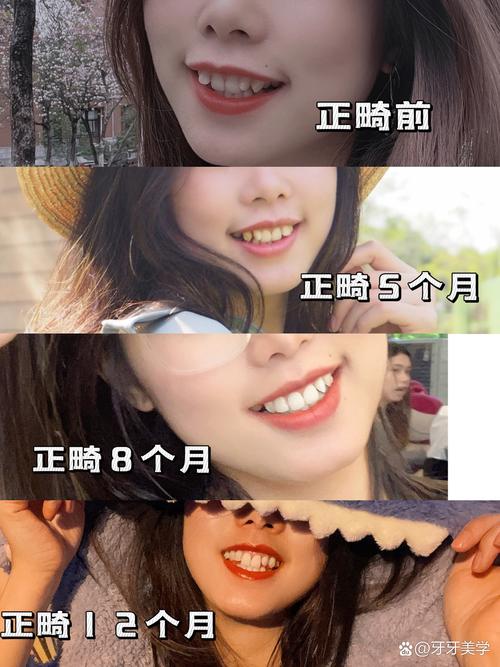 20岁矫正牙齿晚不晚?年龄会影响矫正效果和周期吗?-图2 20岁矫正牙齿晚不晚?年龄会影响矫正效果和周期吗?-图2