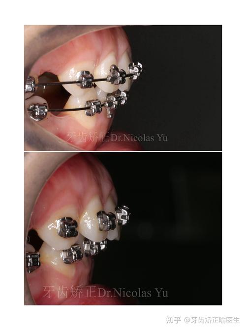 牙齿双颌前突矫正-图1 牙齿双颌前突矫正-图1