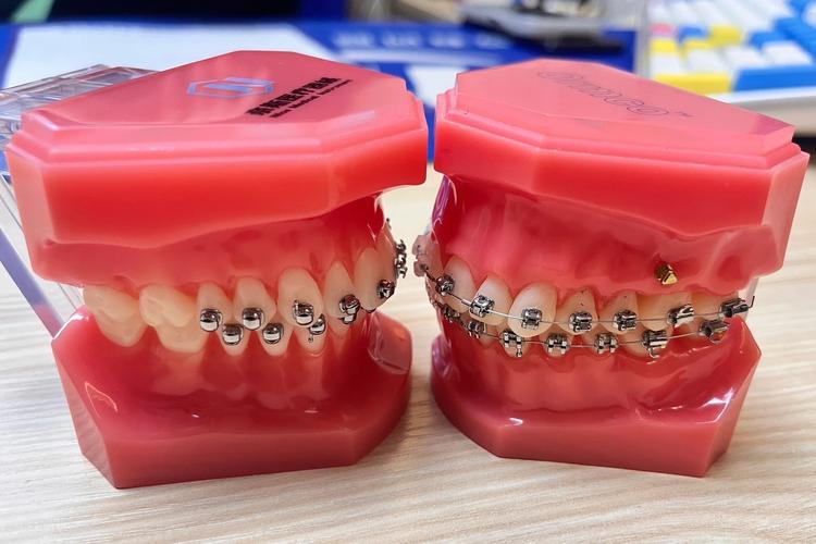 irok牙齿矫正-图3