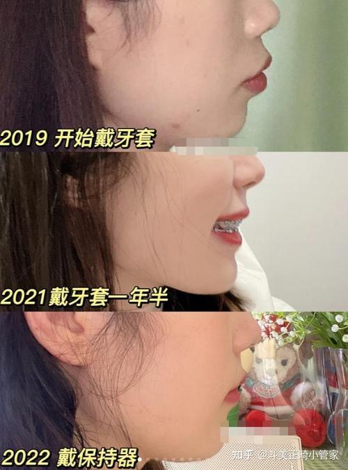贵阳牙齿矫正怎么样?价格效果机构如何选?-图3 贵阳牙齿矫正怎么样?价格效果机构如何选?-图3