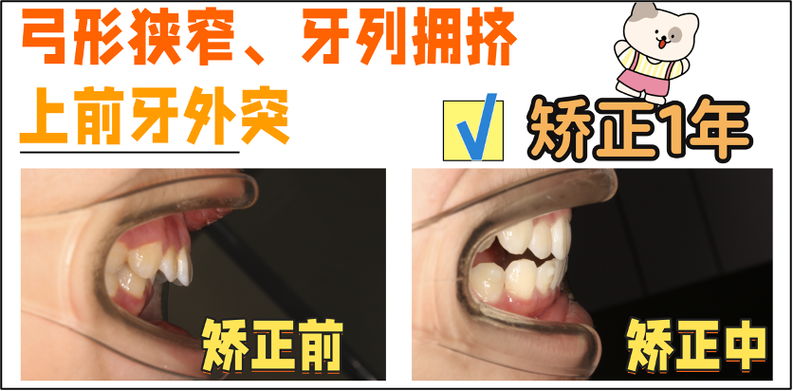牙齿外突矫正,矫正后牙齿和脸型能改善多少?-图1 牙齿外突矫正,矫正后牙齿和脸型能改善多少?-图1