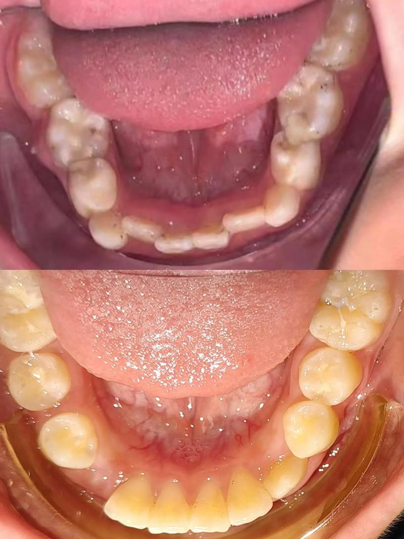儿童牙齿矫正几岁开始最合适？-图2