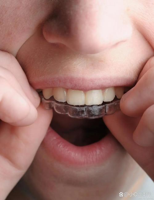 牙齿外突矫正,矫正后牙齿和脸型能改善多少?-图3 牙齿外突矫正,矫正后牙齿和脸型能改善多少?-图3